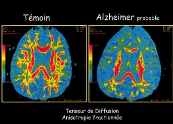 NIH Steps Away From Sponsoring Alzheimer’s Disease Diagnostic Standards